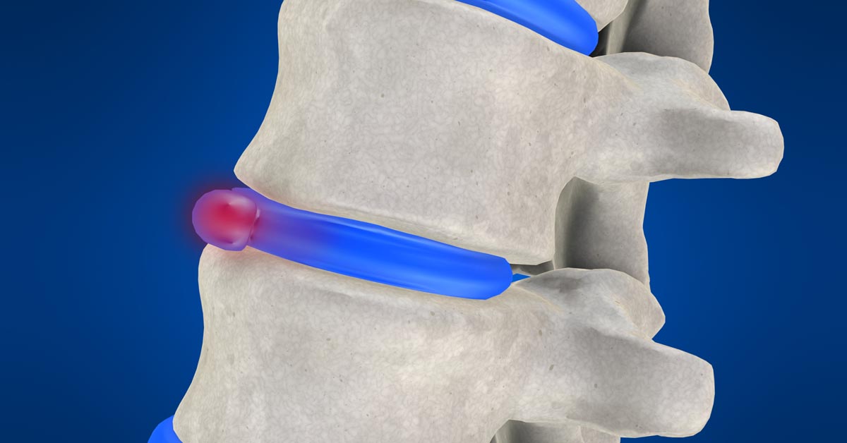 Spinal decompression therapy in Texarkana